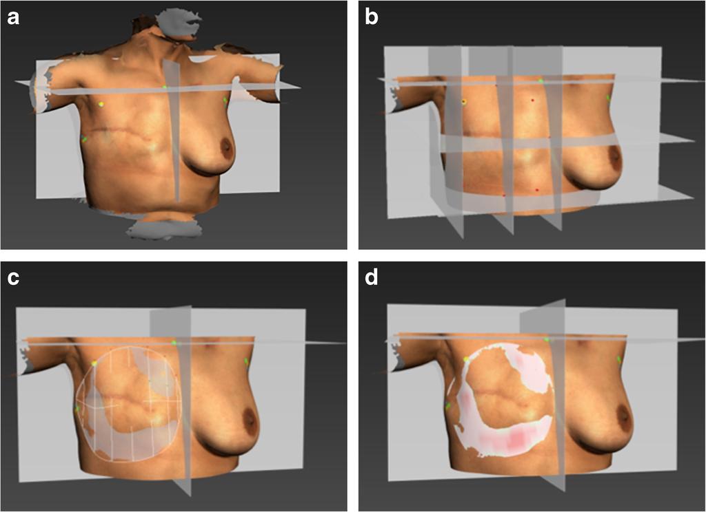 Eur J Plast Surg (2018) 41:663 670 667 Fig. 5 Method of simulating a chest wall.