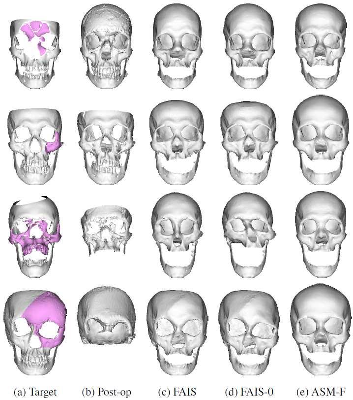 Skull Reconstruction Test Results Test on real defective