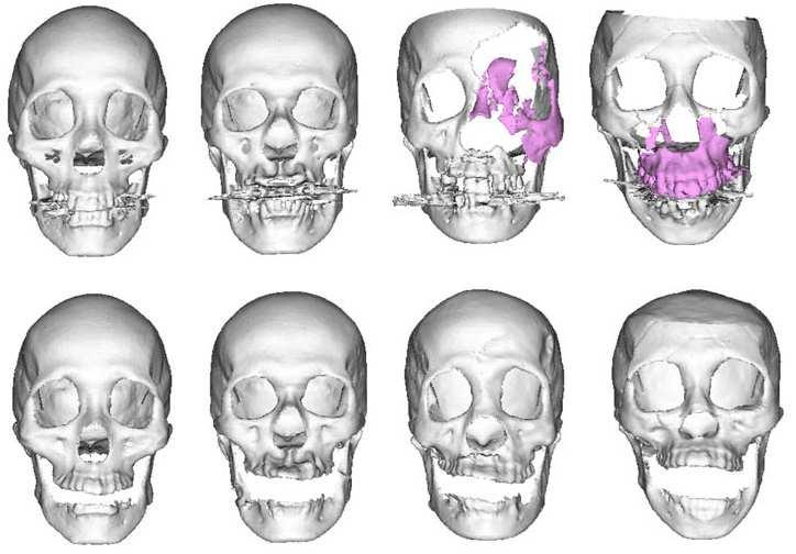 Skull Reconstruction Test Results Reconstructino is robust to x-ray