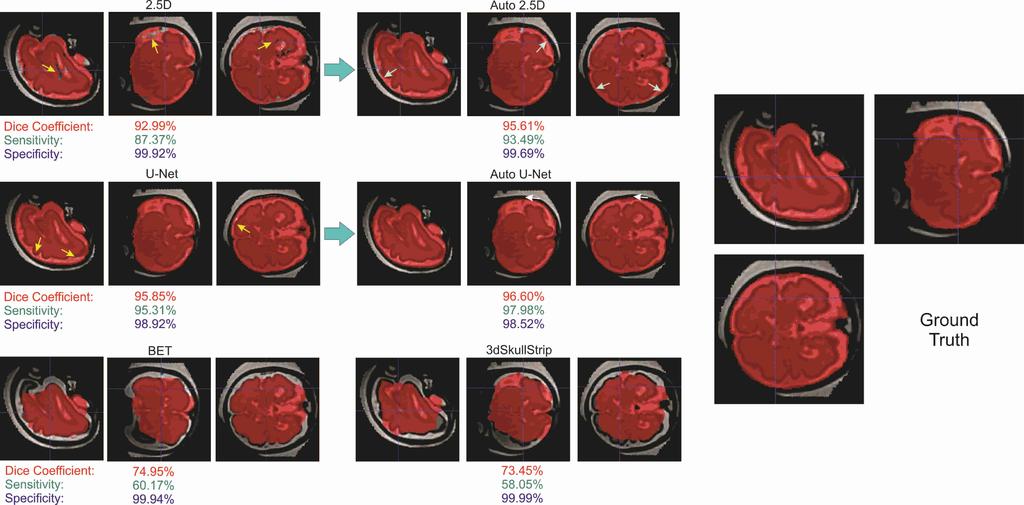 7 Figure 3. Predicted masks overlaid on the data for fetal brain MRI; the top images show the improvement of the predicted brain mask in different steps of the Auto-Net using 2.5D-CNN.