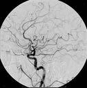 digital subtraction angiography (DSA) create a pre-contrast image, then subtract it from later images after a contrast medium has