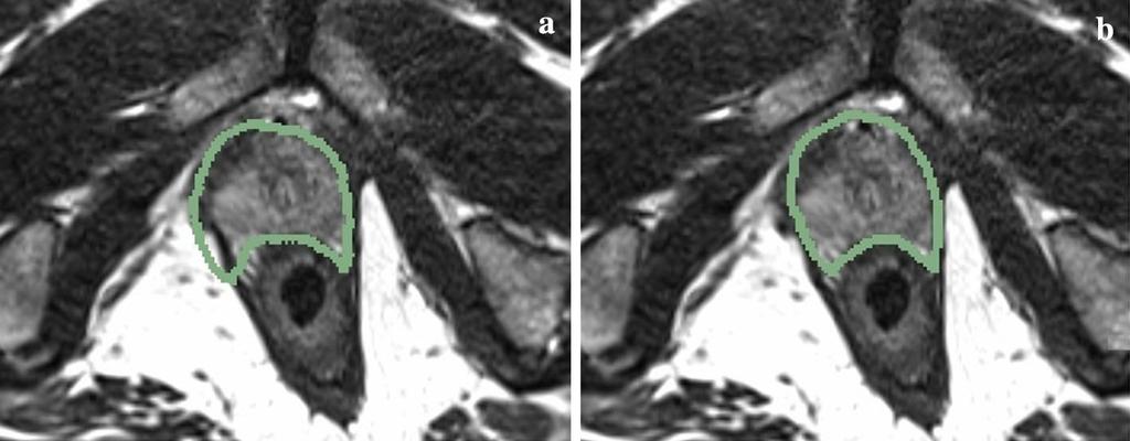 Fig. 7 Examples of prostate contour overlay on the simulated fixed transverse image slice a before registration and b after deformable registration Table 7 TRE statistics for Experiment 2a:
