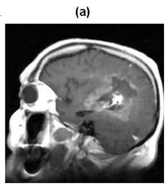 5 Figure 3: MR image an area with a tumor: (a) Original image, (b) Edges found by Canny detector applied to the approximation coefficients, (c) Edges projection into the original image 2.