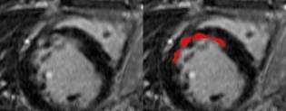 by the automatic method. As we can see in Figure 6, when there is just one scar in the myocardium, the automatically segmented scar is quite similar to the manually one.