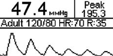 000 Hz; ± 1% Pacemaker Waveforms Amplitude: 3 mv; (± 10% Accuracy) Width: 6 ms; (± 5% Accuracy) Respiration Impedance: Baseline: Delta 3.