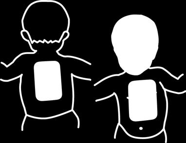 Special Instructions for Use on Young Children Chapter 4 Using the Defibrillator If the patient is a very young child or infant, place the electrode pads on the chest and back, as shown below.