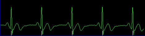 Cardiac Gaiting Cardiac gating monitors cardiac motion by coordinating the excitation pulse with R wave of the