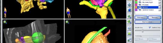 BrainLAB will continue to lead in automatic segmentation with the release of the head & neck lymph level atlas, which includes over 45 objects.