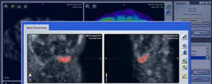 PET Imaging SUV (Standard Uptake Value) Software feature that gives the user advanced