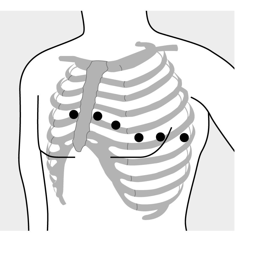 Applying Monitoring Electrodes Figure 4-3 Precordial Lead Electrode Placement Lead Location 1 2 3 4 5 6 V1 C1 forth intercostal space, at right sternal margin V2 C2 forth intercostal space, at left