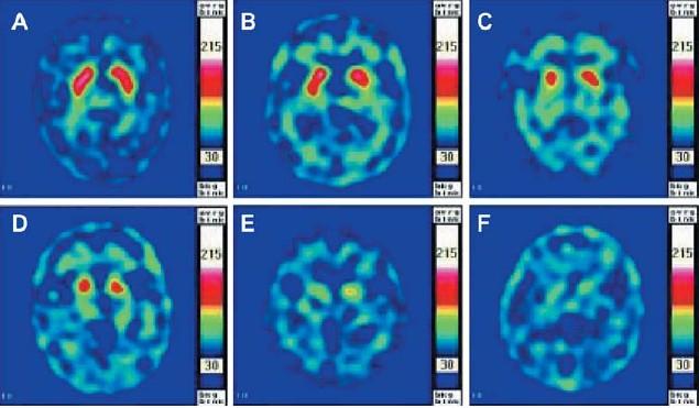 SPECT Imaging in Parkinsonism Imaging assessment: Ø Visual inspection Ø Quantitative studies ü Disease degree, progression, etc.