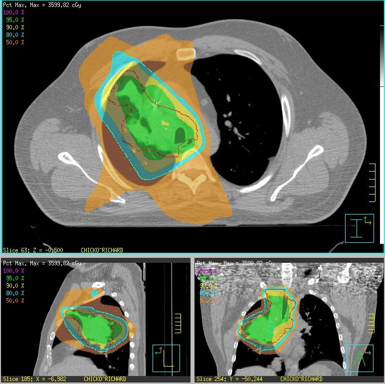 3D conformal radiation therapy Full 3D CT dataset; ICRU 50,62 definition of target
