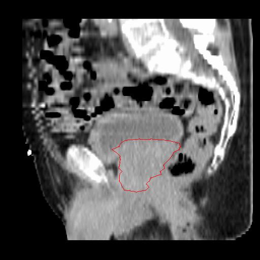 However Increased conformity of IMRT may lead to geographical miss of the tumor
