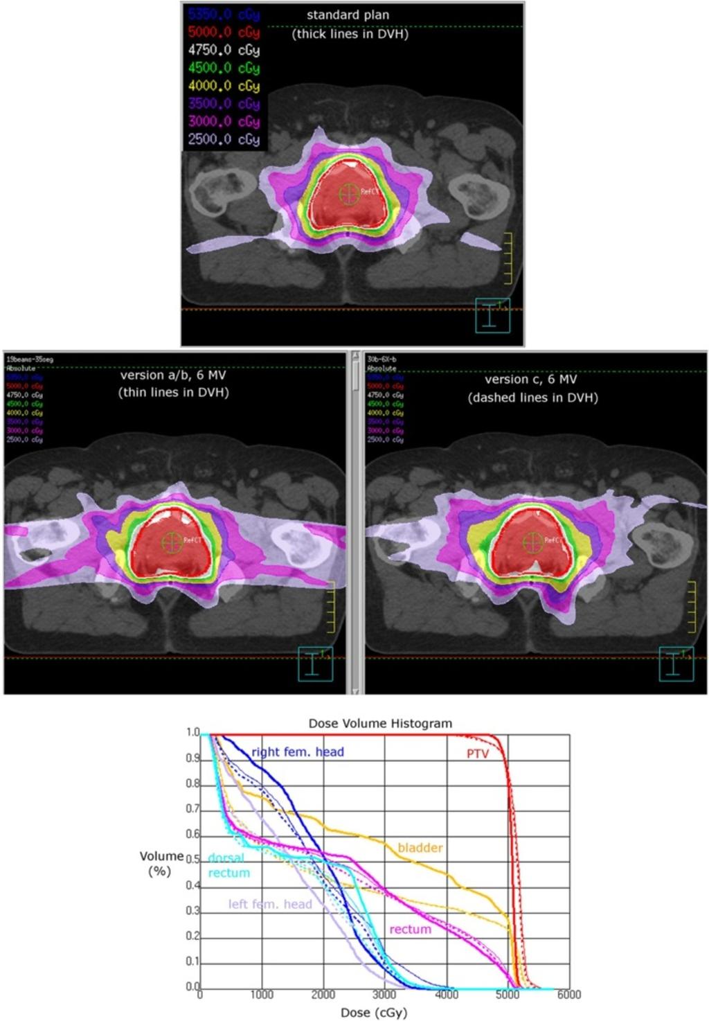 Dzierma et al. Radiation Oncology 2013, 8:193 Page 8 of 13 Figure 3 Example dose distributions of prostate treatment plan.