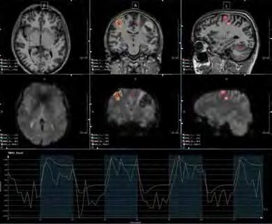 Perfusion Review The Perfusion Review screens include a four-color map displaying relative Cerebral Blood Volume (rcbv), relative Cerebral Blood Flow (rcbf), Mean Transit Time (MTT), and relative