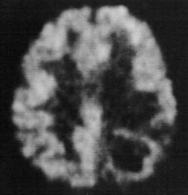 PET Images of Cancer Brain Heart