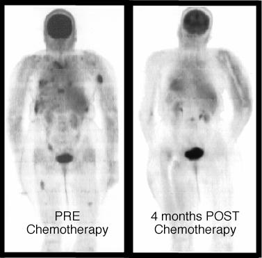 Periphery Metastases Shown with Red