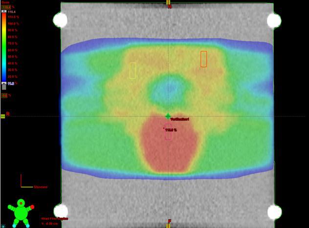 1. Introduction 2 3 1 Figure 1.4 Coronal image showing three regions (shown as blue rectangles) for measuring ionisation chamber dose points in a clinical prostate & nodes IMRT treatment plan.