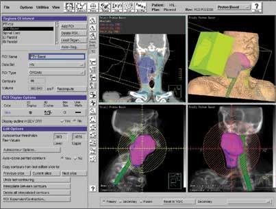 Provide confidence for integrated photon-proton planning Seamless integration within the Pinnacle 3 environment Accelerate clinical adoption with reduced effort Simplified modeling and commissioning