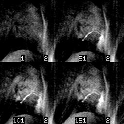 permeating through the tissues in view. Third, the MRI images themselves have noise. Figure 4.
