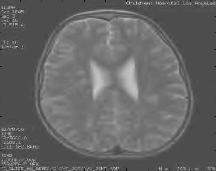 chosen an axial slice of human brain size 512x512 (grayscale) encoded on 8 bits per pixel recorded by means of an MRI scanner (Figure7.). This image is taken from the GE Medical System database [24].