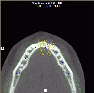 Drag the center tool to adjust Pan Focal Trough. Click the bottom tool to change the Pan view from Radiographic to MIP. 3.