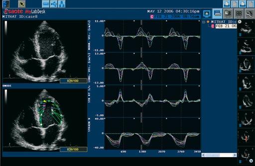 > Contrast Imaging Esaote s proprietary CnTI (Contrast Tuned Imaging) provides high performance