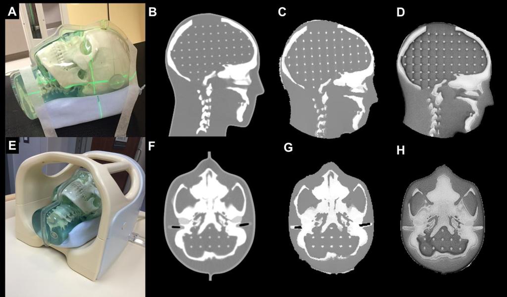 55 Figure 18: (A) MR-CT compatible phantom on CT-SIM table; (B) Sagittal CT; (C) Sagittal synct; (D) Sagittal MRI (inverted UTE); (E) Phantom in 8-channel head coil on MR-SIM table; (F) Axial CT (G)