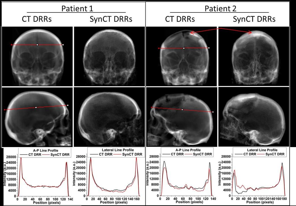 65 Figure 25: Anterior-posterior (top row) and lateral (middle row) CT-DRRs and synct-drrs with respective intensity line profiles for patients 1 and 2.