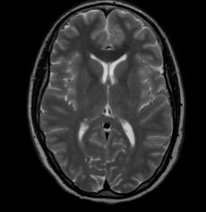 3.1 Contrast Weighted Imaging 21 T 1 w-images are often referred to as anatomical scans since the T 1 -relaxation in different brain tissues are varying yielding good contrast between different