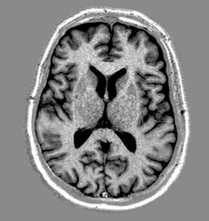 The contrast between white and grey matter is enhanced through the PD-normalization.