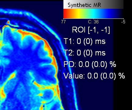 6.3 SyMRI Brain Studio Releases 41 Figure 6.11. The colorbar. 6.2.
