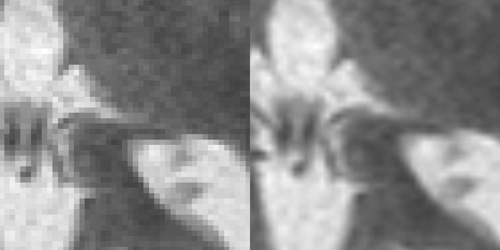 46 Radiologist contrast between white and grey matter is insufficient in the synthetic images. The reason to the lack of contrast is not yet clarified.