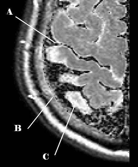 7.1 Radiologist Interaction I 47 Figure 7.2. A) Noisy visualization of CSF, B) Large water-fat shift, C) Healthy tissue appear diseased, D) Lack of anatomic detail.