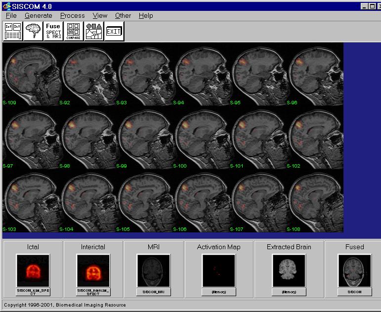 17. If the spatial registration appears correct and the fused image optimal, the Activation Map from the SPECT image can be fused with the SISCOM_MRI and output to a new 24-bit RGB volume image by