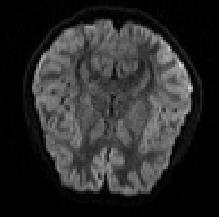 Head motion in diffusion MRI Head motion during a dmri scan can lead to: Misalignment between consecutive DWI volumes in the series Attenuation in the intensities of a