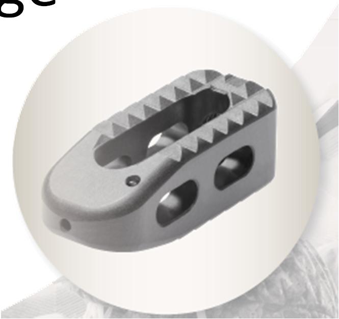 Interbody Cage Is a prosthesis used in spinal fusion Placed between the vertebral