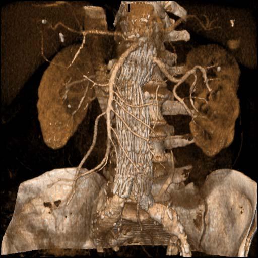 Abdominal CT Angiography Aortic