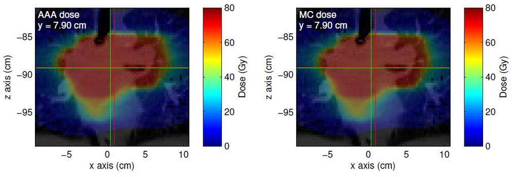 15 Coronal view of AAA and MC dose-to-water in the high-dose plane for the lung case.