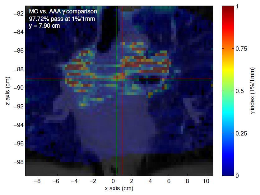 59 Figure 3.19 Coronal view of AAA to MC (dose-to-water) gamma comparison in the high-dose plane for the lung case. Gamma threshold was set to 1%/1mm.