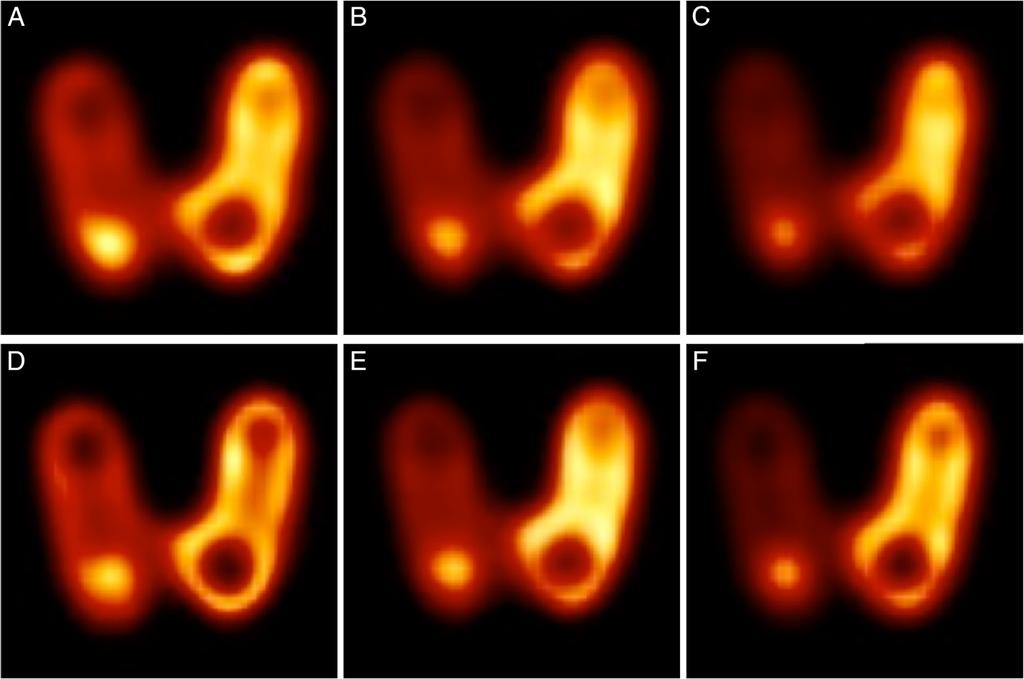 Seret et al. EJNMMI Research 2012, 2:45 Page 12 of 19 Figure 6 Coronal reconstructed slices of the Picker s thyroid phantom. (A, B, C) Six iterations. (D, E, F) 24 iterations.