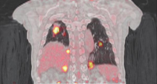Respiratory Gating By synchronizing exposure to the patient s breath, gating creates detailed images for lung cancer patients.
