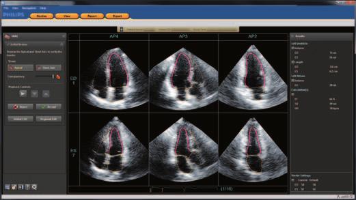 Philips Q-Station workflow software allows you to streamline workflow for ultrasound data management, while performing advanced analysis and quantification of patient s image data.