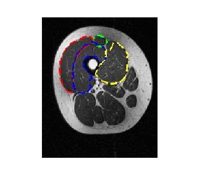 Segmentation of CT imaging