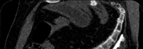 Example: Anisotropic Diffusion (CED, Weickert) Abdominal CTA scan (medium noise level)