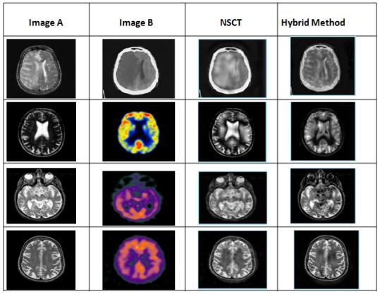 Figure 5.1: Fused images of MRI and SPECT images of Brain affected Alzheimer. 5.1.2 Experiment with data set 2: Stroke Results of fusion of scan images of Brain affected Stroke.