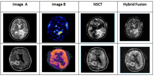 4: Fused Scan images of Brain affected Glioblastoma. Figure 5.2: Fused images of MRI and SPECT images of Brain affected stroke. 5.1.