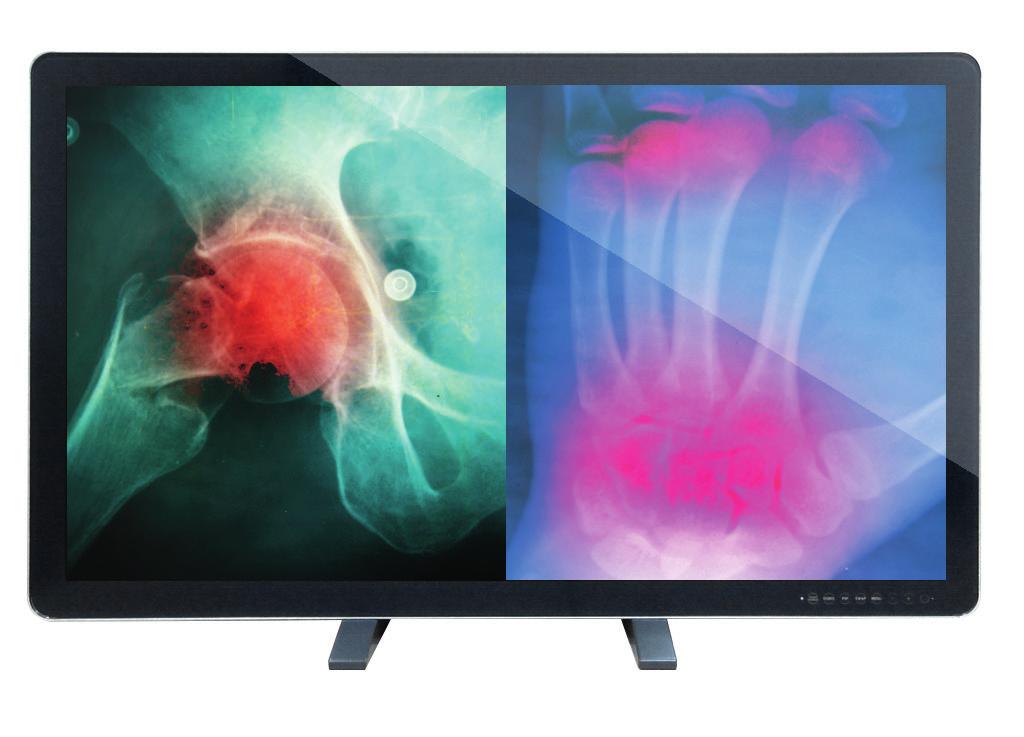 4K Displays 55 4K Display (Quad Full-HD / Ultra HD resolution with 3840 2160) True Flat design with protection glass and IP 65 front POP / PIP / PBP multiple picture support Medical certified display