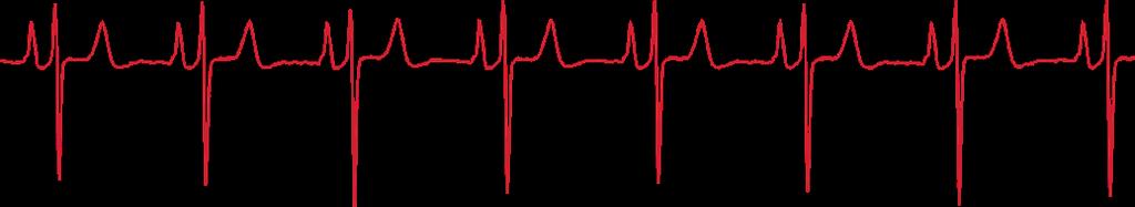 Graphics Heart Wave The Heart Wave graphic depicts a high-quality ECG signal interpreted directly from a Bardy Diagnostics CAM Report.