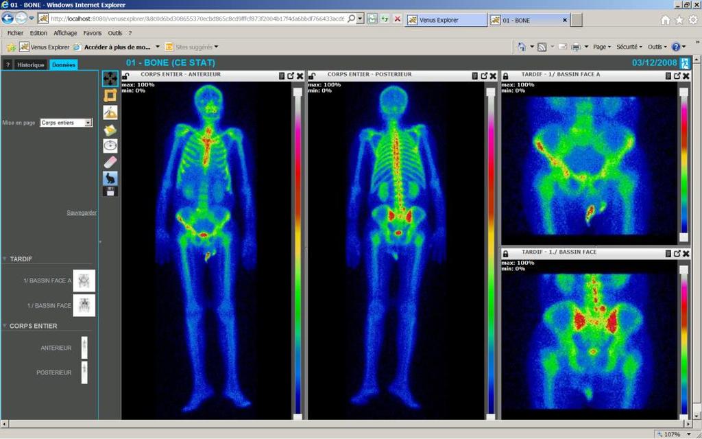 Bones Clinical application for review and analysis of bone scintigraphy studies.